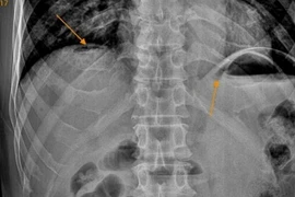 Thường xuyên uống rượu, người đàn ông bị thủng tạng rỗng