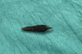 Ăn yến chưng nuốt luôn hạt táo đỏ, người phụ nữ bị thủng ruột