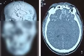 Người đàn ông 45 tuổi bị thương tích nặng vùng đầu, mặt do pháo nổ