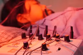 Bé gái 4,5 tuổi bị liệt dây thần kinh số 7 ngoại biên do lạnh