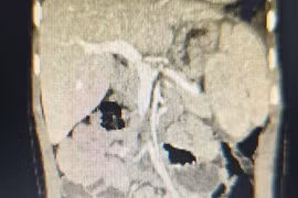 Phẫu thuật cứu trẻ thoát vị hoành thận lạc chỗ trên lồng ngực, phổi biệt lập