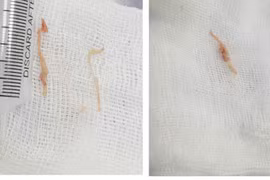 Trẻ bị sặc thức ăn - phụ huynh không nên chủ quan