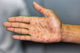 Những bệnh lây truyền qua đường tình dục phổ biến nhất