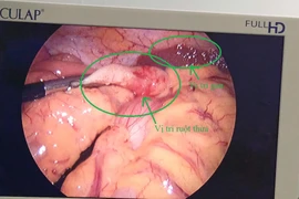 Nội soi cắt viêm ruột thừa ở vị trí hiếm gặp