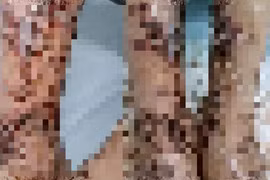 Viêm da nhiễm trùng nặng sau lội nước đắp lá