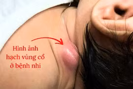 Hạch vùng đầu mặt cổ ở trẻ em có nguy hiểm?