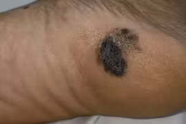 Phát hiện mắc ung thư từ nốt đen lạ ở gót chân