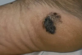 Phát hiện mắc ung thư từ nốt đen lạ ở gót chân