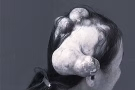 Bệnh ung thư khiến người phụ nữ "mọc sừng" kỳ lạ trên đầu