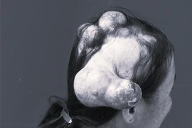 Bệnh ung thư khiến người phụ nữ "mọc sừng" kỳ lạ trên đầu