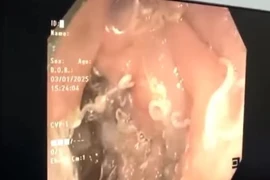 Giật mình hàng trăm con giun "trú ngụ" trong đường tiêu hóa người phụ nữ