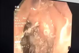 Giật mình hàng trăm con giun "trú ngụ" trong đường tiêu hóa người phụ nữ