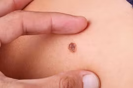 Ung thư da từ 1 nốt chấm nhỏ sẫm màu, bác sĩ cảnh báo