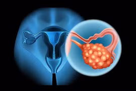 Buồng trứng đa nang làm tăng nguy cơ cao huyết áp ở tuổi vị thành niên