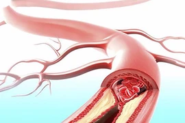 Mách bạn công thức "vàng" làm sạch mạch máu hiệu quả