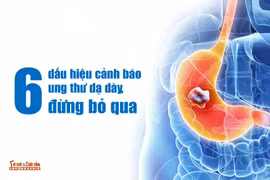 6 dấu hiệu cảnh báo ung thư dạ dày, đừng bỏ qua