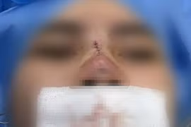 Cô gái trẻ bị thủng mũi sau 3 tháng căng chỉ nâng mũi