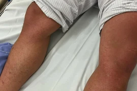 Nhiều ca sốt xuất huyết nặng, biến chứng nguy hiểm: Cảnh báo từ bác sĩ