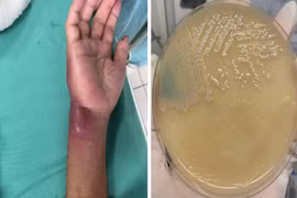 Hoà Bình: Phát hiện 2 ca nhiễm "vi khuẩn ăn thịt người"