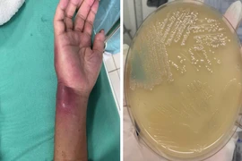 Hoà Bình: Phát hiện 2 ca nhiễm "vi khuẩn ăn thịt người"