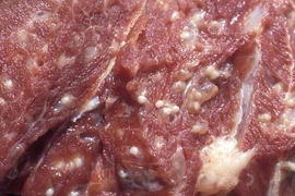 Ho nhiều, chảy nước mũi... bệnh nhân được chẩn đoán nhiễm sán dây lợn