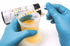 Nước tiểu sẫm màu cảnh báo điều gì về sức khoẻ?