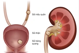 Phẫu thuật lấy sỏi thận to hơn quả trứng gà cho bệnh nhân 63 tuổi