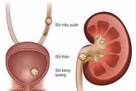 Phẫu thuật lấy sỏi thận to hơn quả trứng gà cho bệnh nhân 63 tuổi