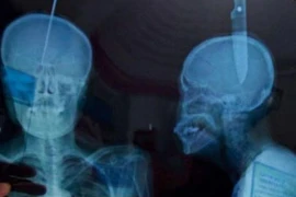 Video: Kinh dị người đàn ông tự đâm dao xuyên đầu để...thở tốt hơn