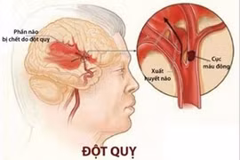 Có những dấu hiệu này, bạn cần đi khám tim mạch ngay