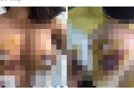 Hãi hùng những bộ ngực biến dạng sau nâng cấp đặt túi ngực