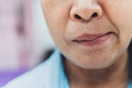 Liệt mặt, méo miệng sau khi ngủ phòng điều hòa, phòng tránh thế nào?