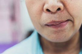 Liệt mặt, méo miệng sau khi ngủ phòng điều hòa, phòng tránh thế nào?