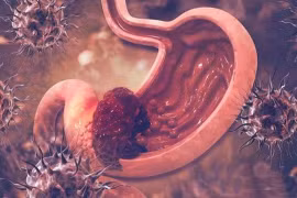 Làm 3 điều này, bạn có thể ngăn ngừa ung thư dạ dày