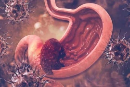 Làm 3 điều này, bạn có thể ngăn ngừa ung thư dạ dày