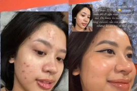 Ngã ngửa mặt mộc chi chít mụn hot girl nổi tiếng gốc Thanh Hóa