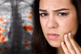 Dấu hiệu lộ trên mặt của ung thư phổi nhưng ít người biết