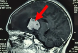 Phát hiện u não ác tính hiếm gặp sau cơn đau đầu dai dẳng