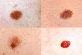 Nốt ruồi mọc ở 4 bộ phận này cần để ý kỹ