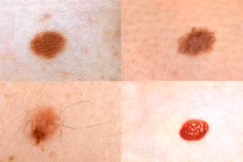 Nốt ruồi mọc ở 4 bộ phận này cần để ý kỹ