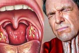 Cách trị dứt điểm viêm họng trong 4 giờ cực đơn giản 