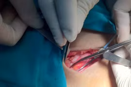 Căn bệnh phổ biến ở bé trai, nguy cơ ảnh hưởng sinh lý