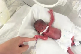 Bé gái sinh non ở tuần thứ 24 nặng 550 g sống sót kỳ diệu