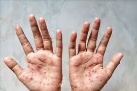 Thủ tướng: Phòng chống đậu mùa khỉ “sớm một bước, cao hơn một mức“