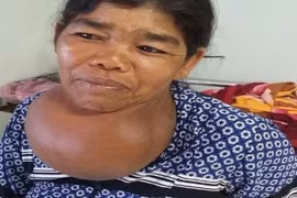 Phẫu thuật thành công ca bướu giáp khổng lồ