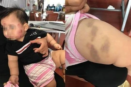 Bà mẹ tố nhà trường bạo hành trẻ em, dân mạng gay gắt lên tiếng