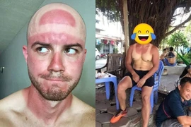 Coi thường mùa hè, netizen khoe chiến tích cháy nắng cực chất