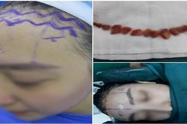 Hãi hùng cô gái cắt da đầu để sửa trán cho bớt cao 