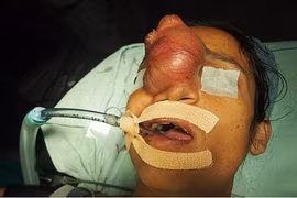 Lần đầu được hôn chồng nhờ phẫu thuật cắt khối u trên mặt