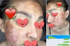 Dùng kem lột da cô gái như bỏng nặng, Trang Nemo bị réo tên